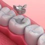 amalgamas dentales